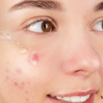 can vitamin c serum cause acne