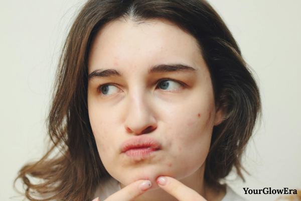 can vitamin c serum cause acne