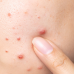 best natural face moisturizer for acne prone skin