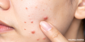 best natural face moisturizer for acne prone skin