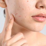 best natural face moisturizer for acne prone skin