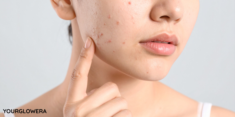 best natural face moisturizer for acne prone skin
