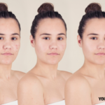 Acne treatment before and after