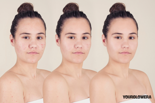 Acne treatment before and after