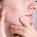 Ayurvedic treatment for acne scars