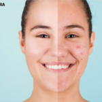 Acne treatment before and after