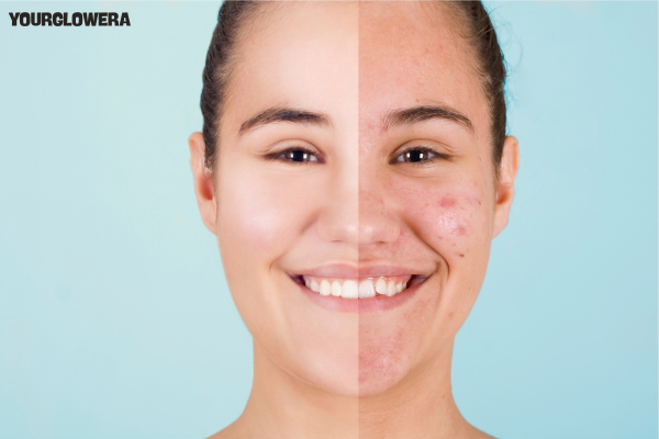 Acne treatment before and after