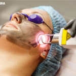 Laser treatment for acne cost in india