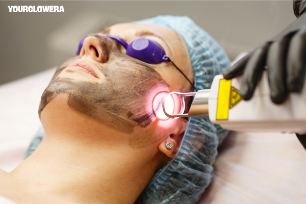 Laser treatment for acne cost in india