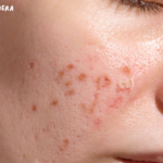 Laser treatment for acne scars cost in india