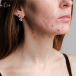 Acne scar treatment cost