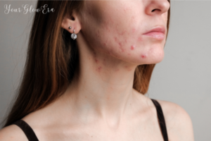 Acne scar treatment cost