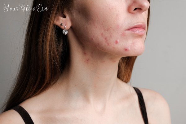 Acne scar treatment cost