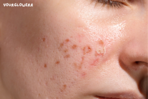 Laser treatment for acne scars cost in india