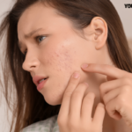 Vcare acne treatment cost
