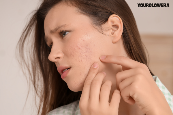 Vcare acne treatment cost