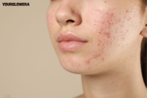 Vcare acne treatment cost