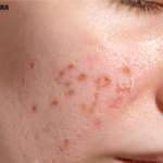 Laser treatment for acne scars price in india