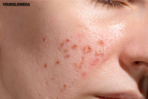 Laser treatment for acne scars price in india