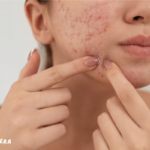 Mnrf treatment for acne scars