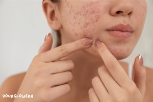 Mnrf treatment for acne scars