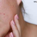 Mnrf treatment for acne scars