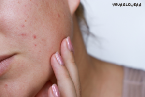 Mnrf treatment for acne scars