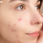 Laser treatment for acne scars price in india