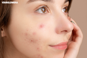 Laser treatment for acne scars price in india