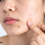 Acne treatment kit