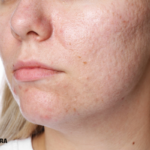 Open pores and acne scars treatment