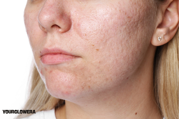 Open pores and acne scars treatment