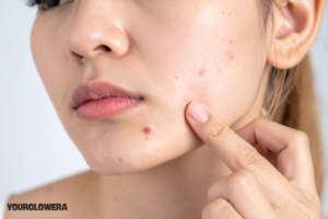Acne treatment kit