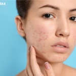 Acne treatment cost