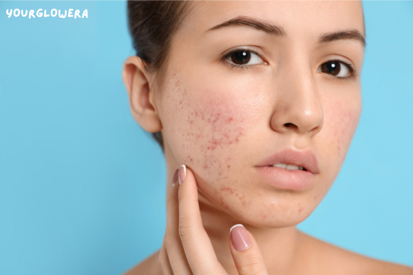 Acne treatment cost