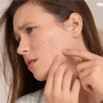 Acne treatment kit