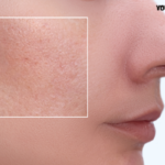 Open pores and acne scars treatment