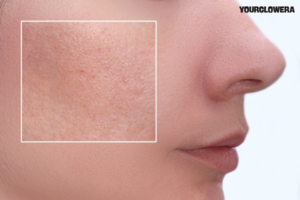 Open pores and acne scars treatment