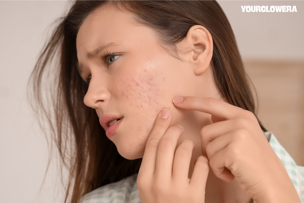 Acne treatment kit