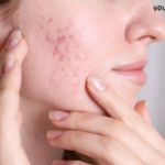 Laser treatment for acne scars cost in india