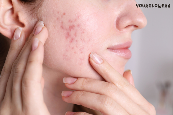 Laser treatment for acne scars cost in india