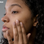 Acne scar treatment price